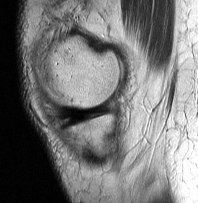 Figure 2 for case Unstable flap tear medial meniscus